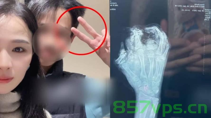 少年遭遇干冰炸伤手指，伤口深可见骨——伤痛与警醒智能免费问答EasyAI m.857vps.cn，少年手指遭干冰炸伤，警醒社会关注安全，伤痛背后的智能问答平台EasyAI分析报道 第1张