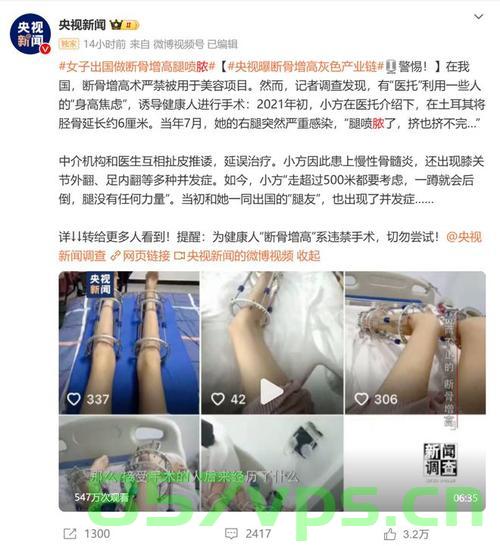 女子出国做断骨增高手术，术后腿喷脓引发关注智能免费问答EasyAI m.857vps.cn，女子出国接受断骨增高手术引发关注，术后腿部感染喷脓引发智能问答热议