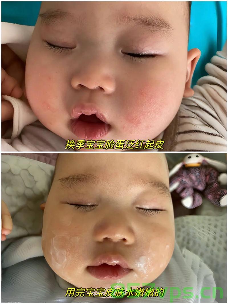 三岁宝宝离奇皮肤状况，全身起皮，脱衣瞬间如雪花纷飞智能免费问答EasyAI m.857vps.cn，三岁宝宝皮肤离奇状况揭秘，全身起皮，脱衣瞬间如雪花纷飞——智能问答解析