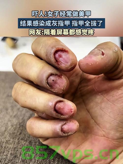 警惕美甲风险，女子因美甲感染HPV病毒长出菜花状病变智能免费问答EasyAI m.857vps.cn，警惕美甲风险，女子因美甲感染HPV病毒引发菜花状病变提醒，警惕美甲风险，女子因不当美甲感染HPV病毒引发菜花状病变警告！，警惕美甲风险，女子不当美甲引发HPV病毒菜花状病变警告！，警惕美甲风险，女子不当美甲引发HPV病毒菜花状病变警告！，警惕美甲风险，不当操作易引发HPV病毒感染出现菜花状病变！，警惕不当美甲操作引发HPV病毒菜花状病变风险警告！，警惕不当美甲操作引发HPV病毒菜花状病变风险！