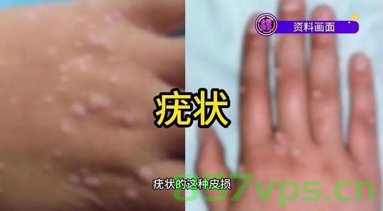 警惕美甲风险，女子因美甲感染HPV病毒长出菜花状病变智能免费问答EasyAI m.857vps.cn，警惕美甲风险，女子因美甲感染HPV病毒引发菜花状病变提醒，警惕美甲风险，女子因不当美甲感染HPV病毒引发菜花状病变警告！，警惕美甲风险，女子不当美甲引发HPV病毒菜花状病变警告！，警惕美甲风险，女子不当美甲引发HPV病毒菜花状病变警告！，警惕美甲风险，不当操作易引发HPV病毒感染出现菜花状病变！，警惕不当美甲操作引发HPV病毒菜花状病变风险警告！，警惕不当美甲操作引发HPV病毒菜花状病变风险！ 第2张