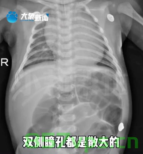 初生婴儿误食蜂蜜水中毒，52天婴儿ICU紧急救治纪实智能免费问答EasyAI m.857vps.cn，初生婴儿误食蜂蜜水中毒，紧急ICU救治纪实，智能免费问答助阵救治行动 第2张