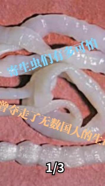 男子体内惊现长达2.73米绦虫，健康警示与防治知识普及智能免费问答EasyAI m.857vps.cn，男子体内发现罕见长绦虫案例，健康警示与防治知识普及——智能问答平台EasyAI解析，男子体内发现长达2.73米绦虫案例，健康警示与防治知识普及——EasyAI智能问答平台解析 第2张