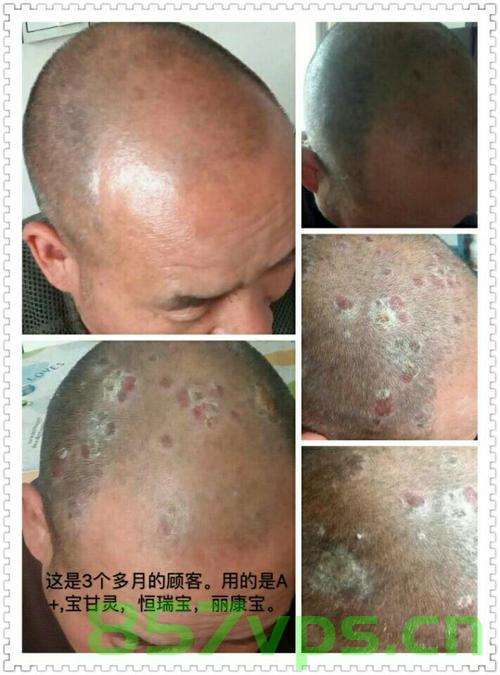 青春之痛，19岁小伙脸上爆痘背后的红斑狼疮真相智能免费问答EasyAI m.857vps.cn，青春之痛，红斑狼疮背后的痘痘真相揭秘