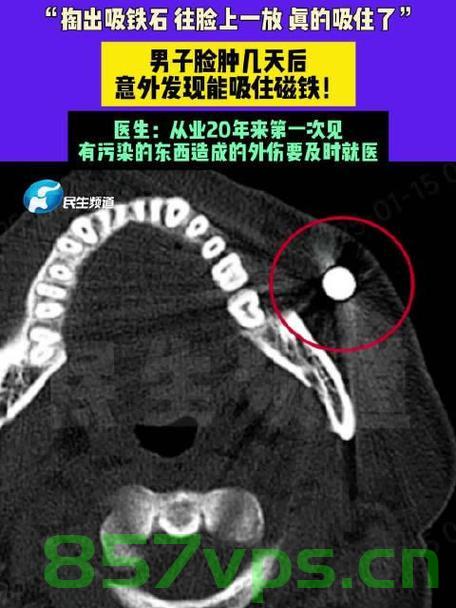 男子脸肿四日后磁铁意外吸附之谜智能免费问答EasyAI m.857vps.cn，男子脸肿四日后磁铁意外吸附之谜揭秘，智能问答平台EasyAI解析揭秘，男子脸肿四日后磁铁意外吸附之谜，EasyAI智能问答平台揭秘真相，男子脸肿四日后磁铁吸附之谜，EasyAI智能问答平台揭秘真相。
