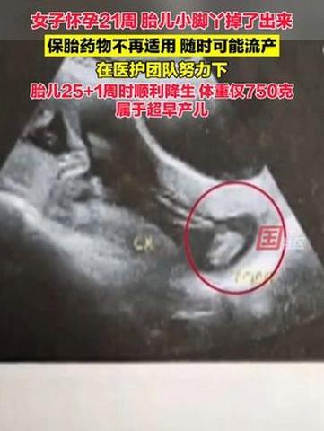 怀孕21周时遭遇胎儿小脚丫掉出的惊险经历智能免费问答EasyAI m.857vps.cn，怀孕21周胎儿小脚丫掉出经历，惊魂一刻的智能问答之旅，怀孕21周胎儿小脚丫掉出经历，惊魂一刻的智能问答之旅分享