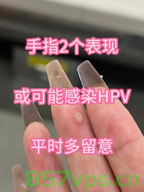 八岁男孩泡温泉引发手指感染HPV，警惕公共场所的健康风险智能免费问答EasyAI m.857vps.cn，八岁男孩泡温泉感染HPV事件敲响警钟，公共场所健康风险需警惕，八岁男孩泡温泉感染HPV事件敲响警钟，公共场所健康风险需警惕，警惕公共场所健康风险智能问答提醒，八岁男孩泡温泉感染HPV事件敲响公共场所健康风险警钟，警惕免费问答提醒，八岁男孩泡温泉感染HPV事件敲响警钟，公共场所健康风险需高度警惕，八岁男孩泡温泉感染HPV事件敲响公共场所健康风险警钟，警惕免费问答提醒，加强健康风险意识教育