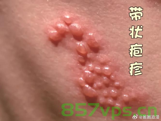 男子头长带状疱疹拔罐引发并发症，最终导致双目失明智能免费问答EasyAI m.857vps.cn，男子拔罐引发带状疱疹并发症致双目失明，智能问答平台易AI解析，男子拔罐引发带状疱疹并发症致双目失明，易AI智能问答解析提醒注意健康风险，男子拔罐引发带状疱疹并发症致双目失明，易AI智能问答解析提醒拔罐需谨慎，健康风险需警惕 第2张