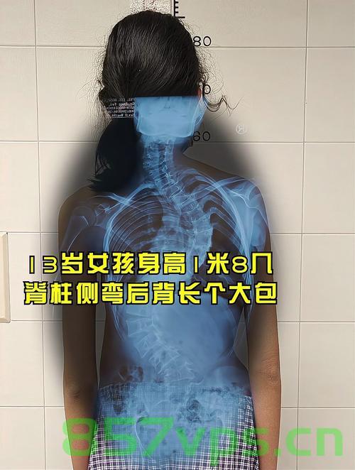 13岁留守女孩脊柱侧弯达80度，逆境中的希望与挑战智能免费问答EasyAI m.857vps.cn，逆境中的希望与挑战，留守女孩脊柱侧弯达重度弯曲，智能问答平台助力免费咨询之路，留守女孩脊柱侧弯达重度弯曲，逆境中的希望与挑战，智能问答平台助力免费咨询之路，留守女孩脊柱侧弯达重度弯曲，逆境中的希望与挑战，智能问答平台免费咨询助力 第2张