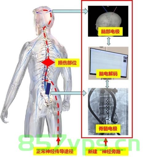 完全截瘫患者在上海走起来了，奇迹与希望的交织智能免费问答EasyAI m.857vps.cn，上海智能问答平台助力完全截瘫患者重新行走，奇迹与希望的交织奇迹与希望的交织，上海智能问答平台助力完全截瘫患者重新行走，奇迹与希望的交织之路