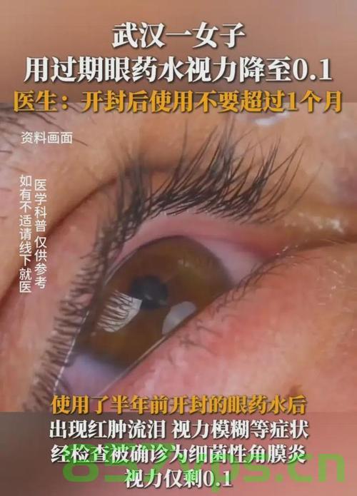 男子误用激素类眼药水导致视力暴跌至0.1的警示故事智能免费问答EasyAI m.857vps.cn，男子误用激素类眼药水导致视力暴跌至0.1的警示故事，智能免费问答平台提醒注意用药安全，男子误用激素类眼药水导致视力暴跌至0.1，警示故事与用药安全提醒 第2张