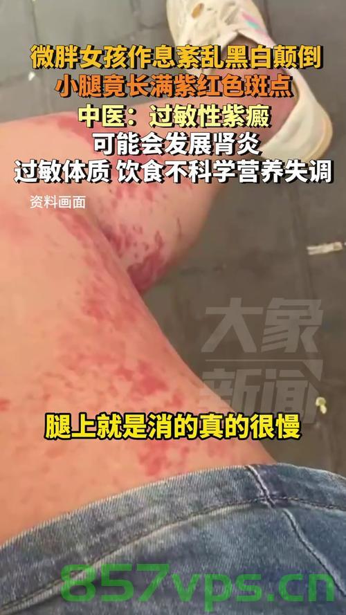 女孩作息黑白颠倒小腿长满紫红色斑——探究生活习惯与健康问题智能免费问答EasyAI m.857vps.cn，女孩作息颠倒引发健康危机，小腿紫红色斑背后的警示与生活习惯探究，女孩作息颠倒引发健康危机，小腿紫红色斑背后的警示与生活作息探究