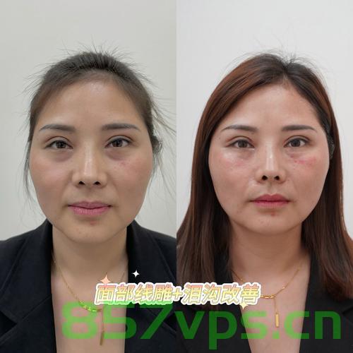 女子线雕手术三年后脸上钻出一根线，经历、反思与警示智能免费问答EasyAI m.857vps.cn，女子线雕手术后意外遭遇钻出线，经历反思与警示揭秘智能问答背后的风险 m.857vps.cn