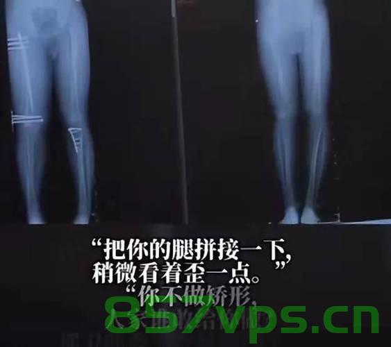 女子花巨款断骨增高遭遇风险，痛苦的后遗症困扰生活智能免费问答EasyAI m.857vps.cn，女子巨款断骨增高遭遇风险，增高手术的后遗症困扰生活，女子巨款断骨增高遭遇风险，增高手术的后遗症困扰生活 第2张