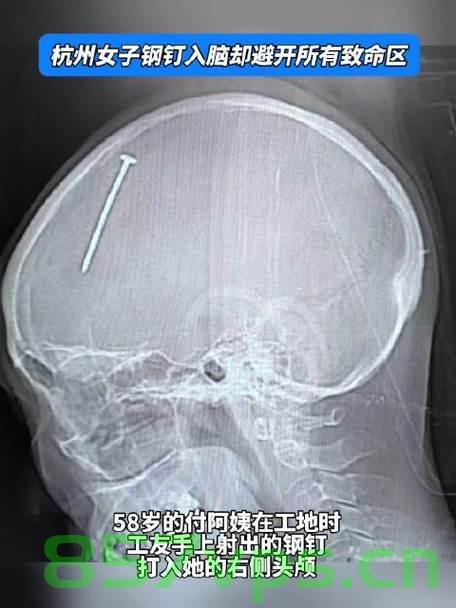 女子大脑惊现六厘米钢钉，奇迹般避开所有致命区域智能免费问答EasyAI m.857vps.cn，女子大脑惊现六厘米钢钉奇迹生还，医生惊叹智能免费问答揭秘救治过程，女子大脑惊现六厘米钢钉奇迹生还，医生揭秘救治过程与智能问答探寻救治真相 第2张